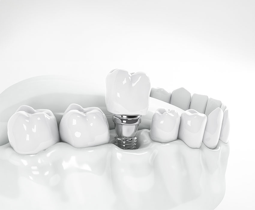 Dental Implants